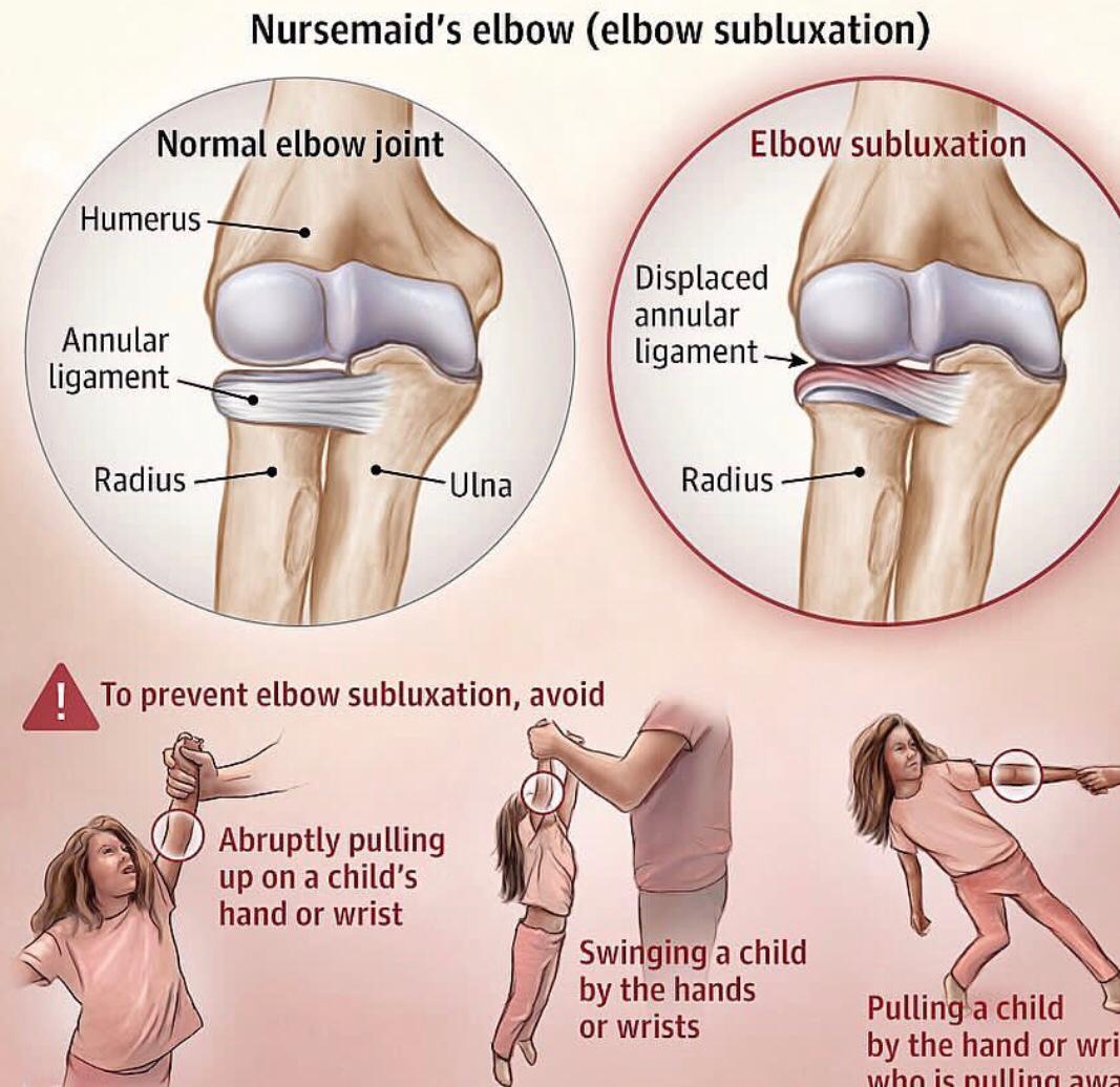Elbow Subluxation